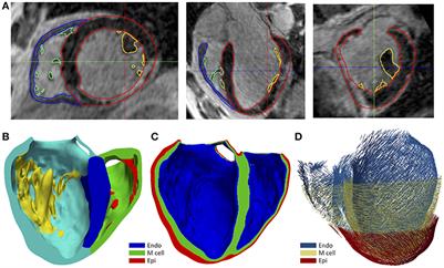 Personalized Cardiac Computational Models: From Clinical Data to Simulation of Infarct-Related Ventricular Tachycardia